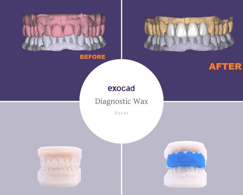 Diagnostic Wax up dental