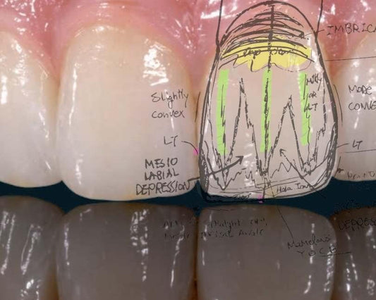 Leyered Zirconia Crowns