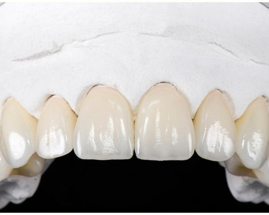 Lithium Disilicate Crowns