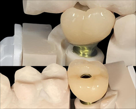 Types of Implant Crowns