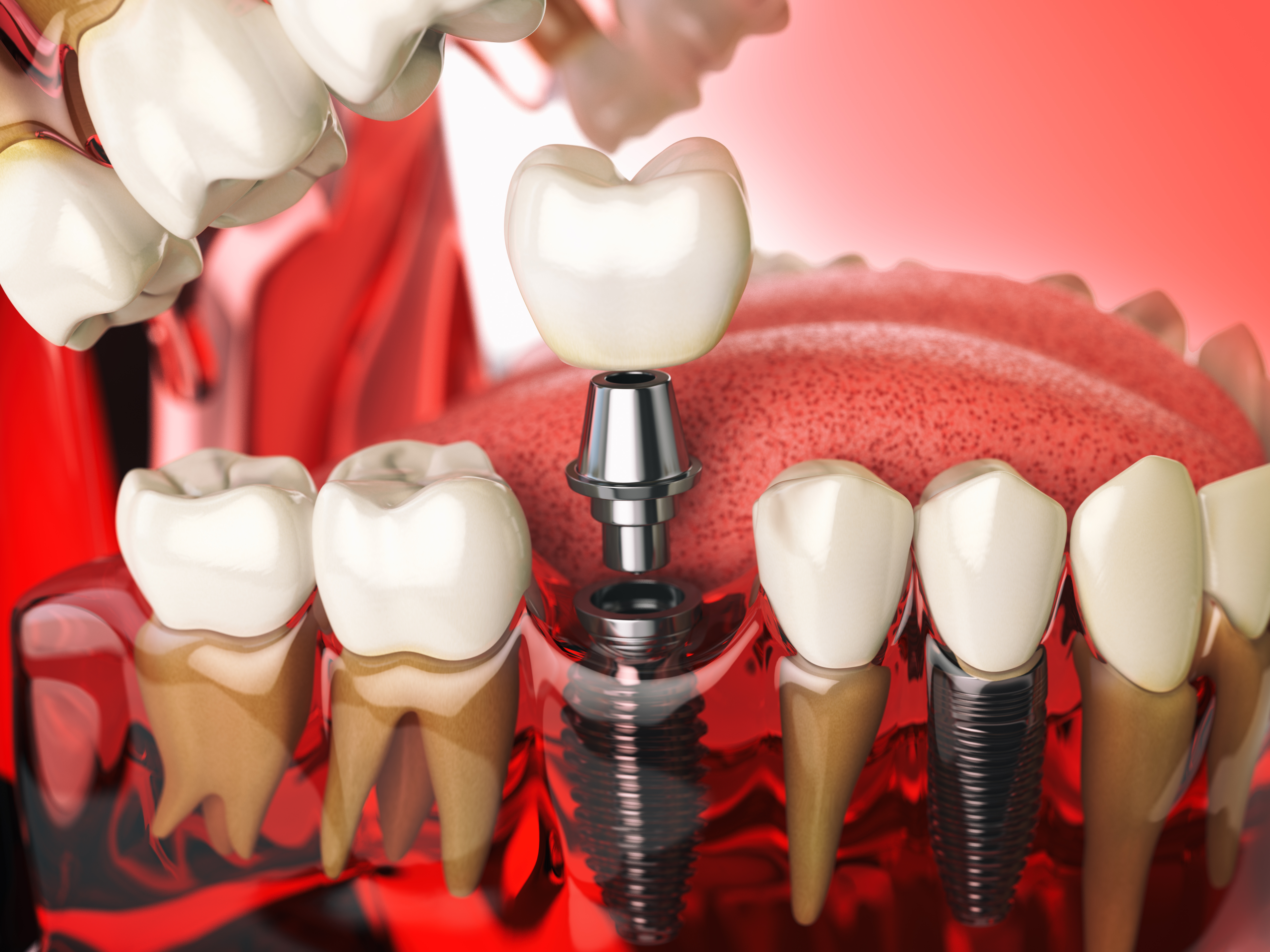 Implant detail