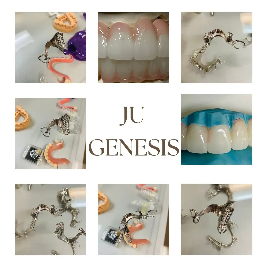 Partial denture example 2
