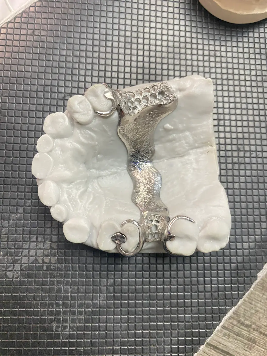 Partial denture example 3