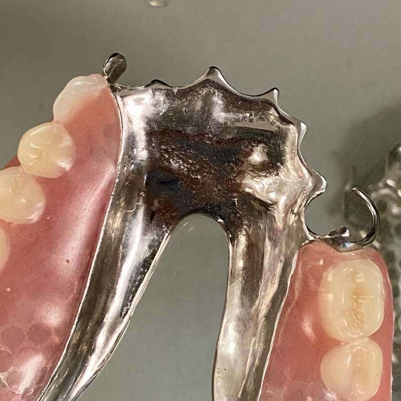 Partial denture example 4