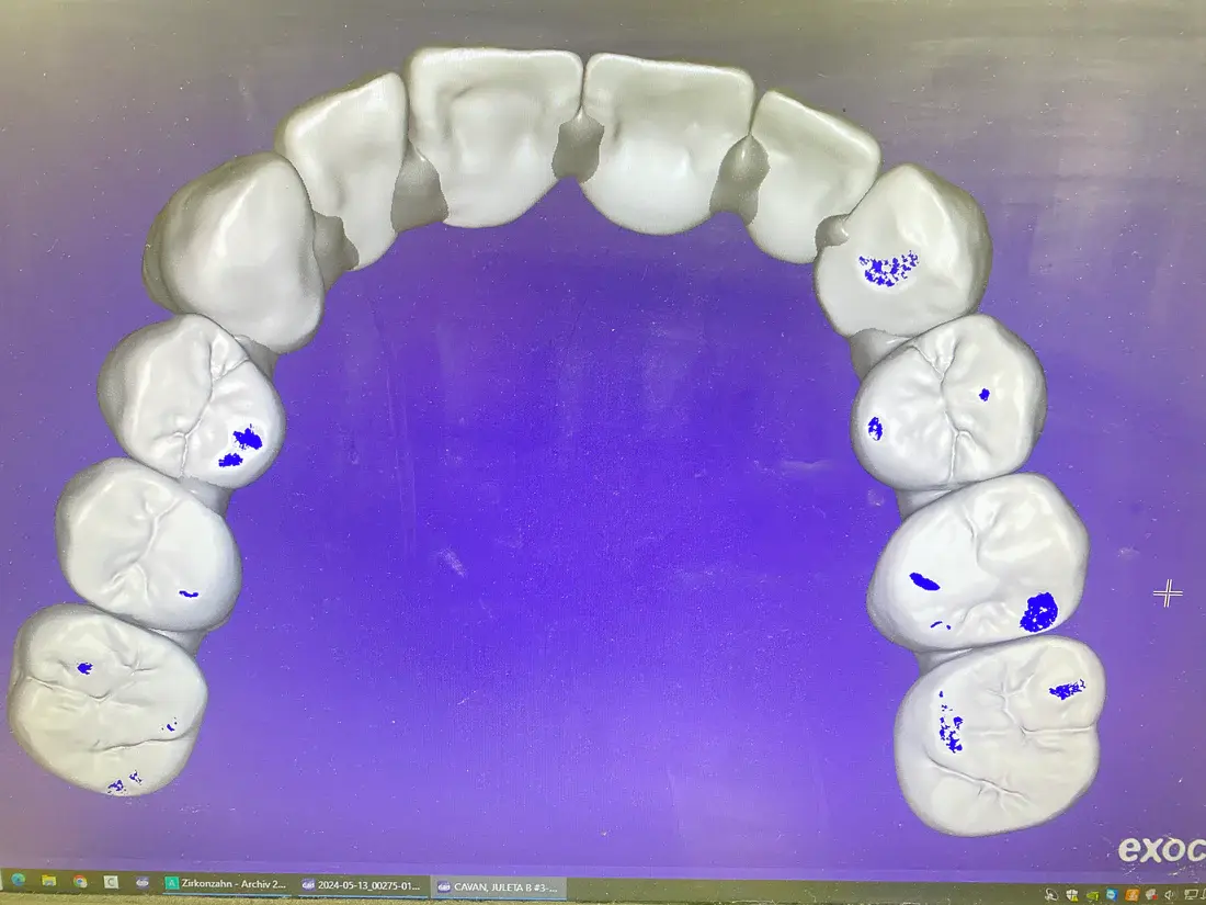 Zirconia Case
