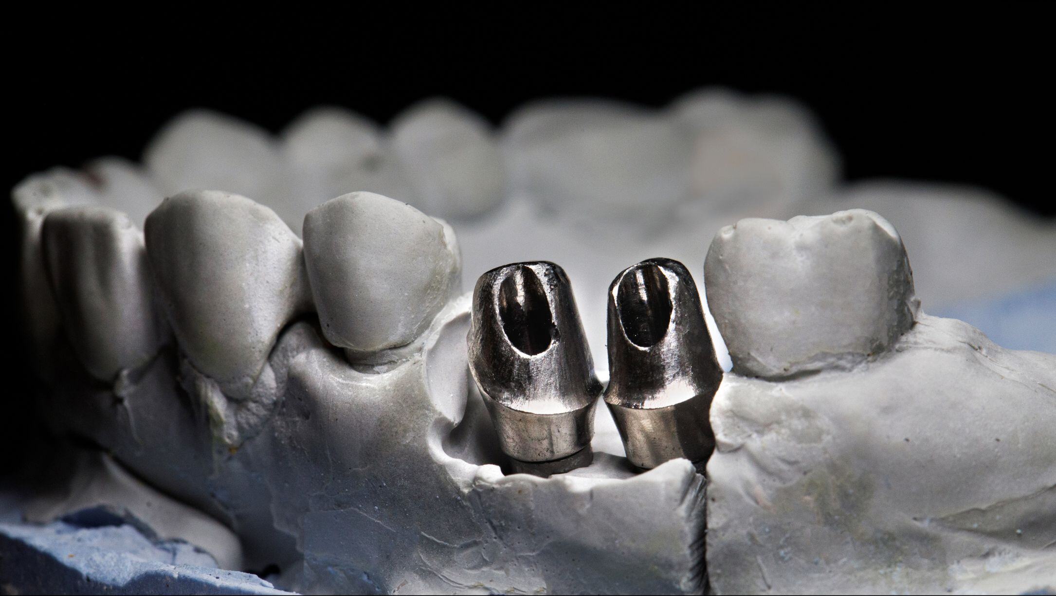 Custom Abutment Detail